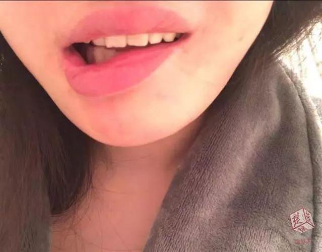 24岁女孩花3.5万整容,嘴巴却歪了 | 8个月后医生的话让她崩溃